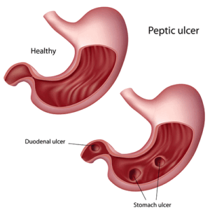 duodenal-ulcer-inline-cccbfb