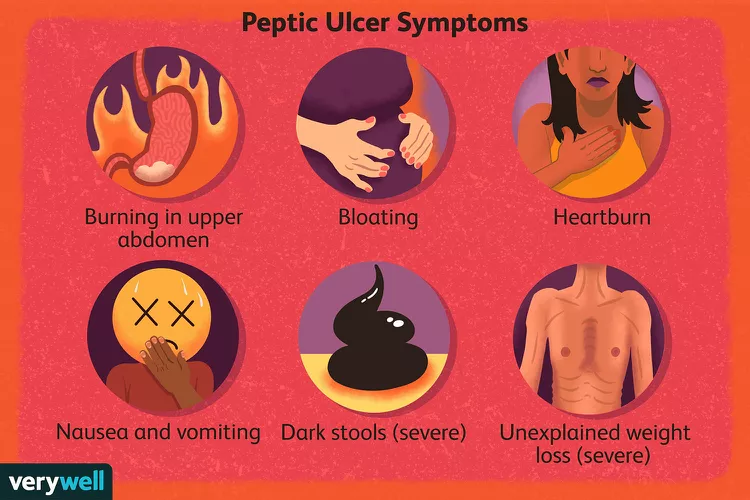 peptic-ulcer-disease-diagnosis-4707600_final-51498411f53a44d8bc49efda9d31e2fd